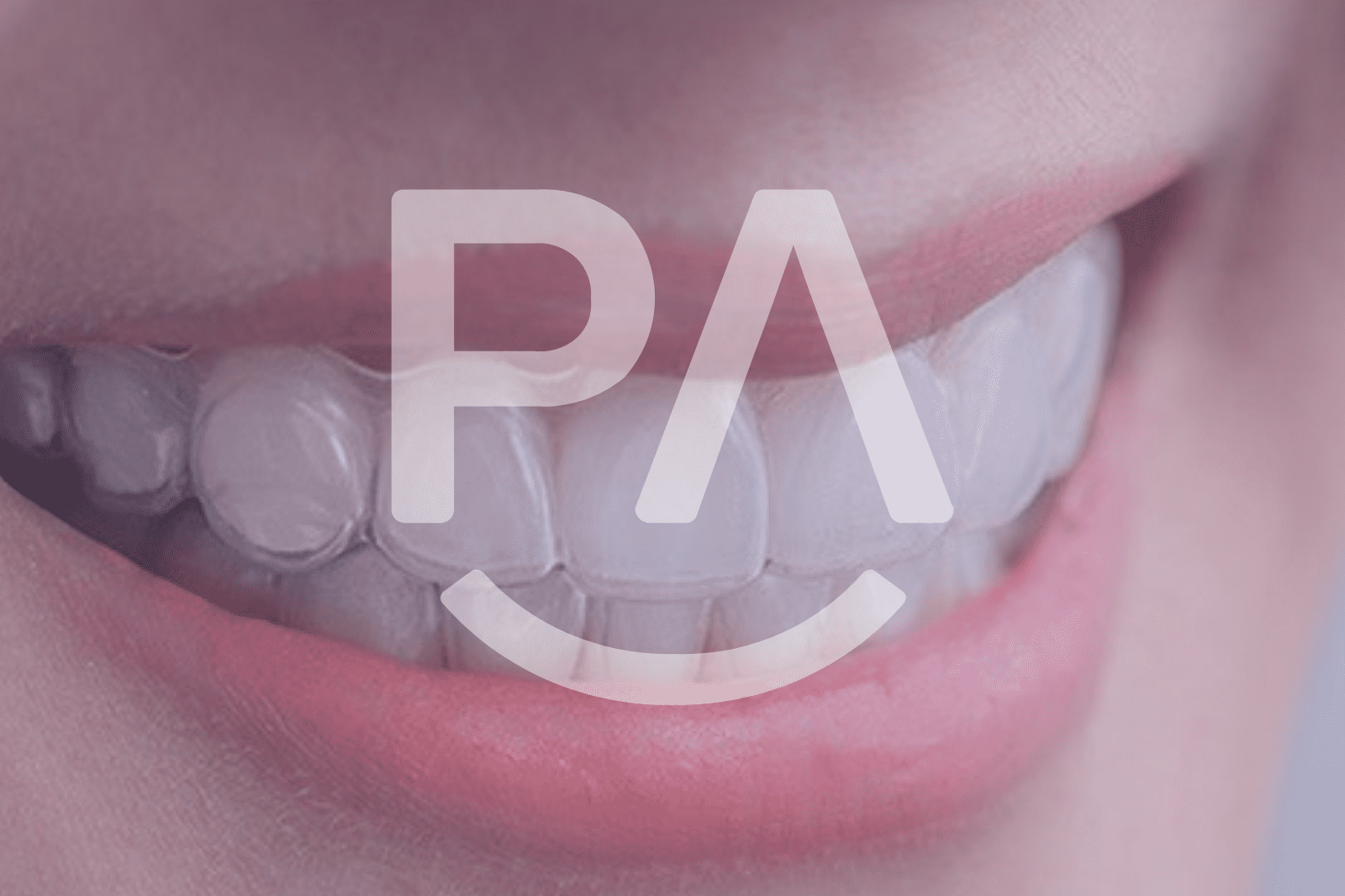 Transformación de sonrisas con los alineadores transparentes ParisAline